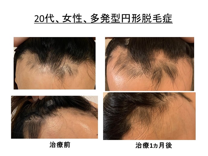 円形脱毛症　病院